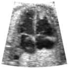 b. Speckle noise reduction by diffusion filter, T=2.