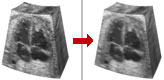 Article 12. 3D median filter - ultrasound image despeckling.